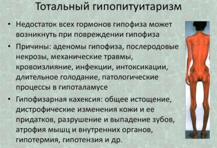 Відхилення гіпофіза головного мозку симптоми порушення функцій