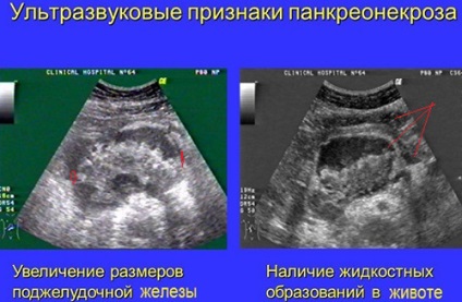 Necroza pancreatică a simptomelor pancreatice și tratamentul formei acute de necroză pancreatică grasă