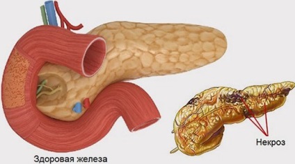 Necroza pancreatică a simptomelor pancreatice și tratamentul formei acute de necroză pancreatică grasă