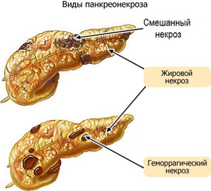 Necroza pancreatică a simptomelor pancreatice și tratamentul formei acute de necroză pancreatică grasă