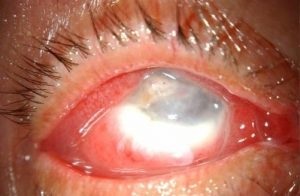 Panophthalmită simptome, cauze de manifestare, tratament modern