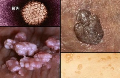 Papilloma simptomelor vezicii urinare și de tratament la bărbați și femei