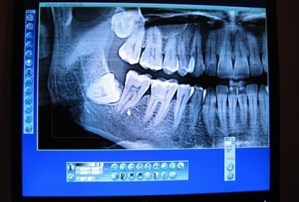 Parodontoza - simptome, cauze și prevenirea parodontozei gingivale - portal dentar