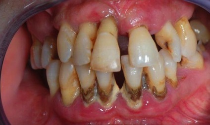 Parodontoza - simptome, cauze și prevenirea parodontozei gingivale - portal dentar