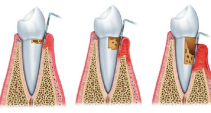 Parodontoza - simptome, cauze și prevenirea parodontozei gingivale - portal dentar