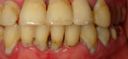 A periodontális betegség kezelési rend otthon