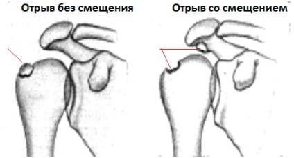 Fractură a unei bătăi mari de tratament cu humerus, simptome și prim ajutor