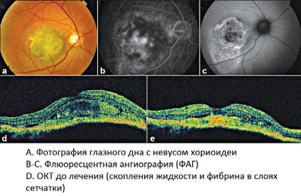 Nevusul pigmentar al coroidului ochiului - cauze, simptome și tratament (îndepărtare) la Moscova la prețuri accesibile