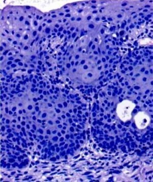 Metaplasia Ploskokletochnaya și zona congenitală de transformare