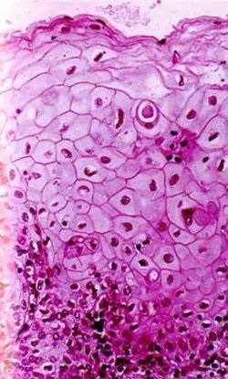 Metaplasia Ploskokletochnaya și zona congenitală de transformare