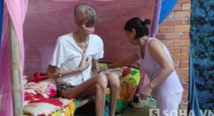 Bacteria carnivore a mâncat fața unui vietnamez