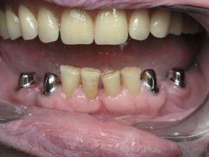 Покривний зубний протез, його переваги, види кріплення, огляд з цінами клінік Москви