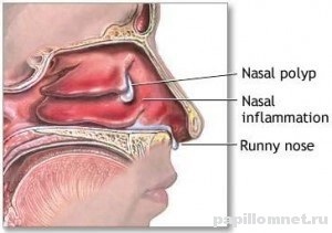 Polipi în nas la adulți și copii simptome și cauze