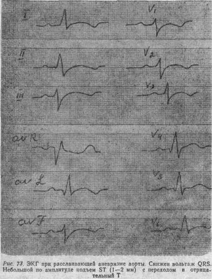 Manualul pe ecg (manual) - decodarea ekg