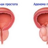 Povtnitsa - cum să vindeci o conspirație transpirație