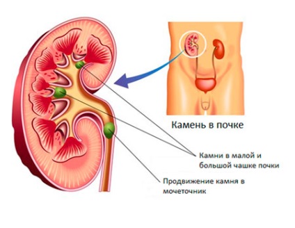 Cauza pietrelor la rinichi este creșterea concentrației de săruri în urină