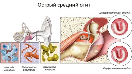 Причини отиту у дорослих - що викликає отит і як можна цього уникнути