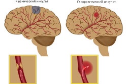 La ce presiune apare accidentul vascular cerebral?