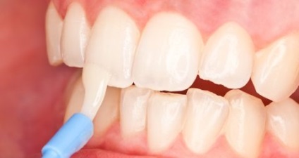Megelőzése betegségek a fogak és az íny - módszerek, technikák, és módok kialakulásának megelőzésében