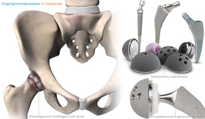 Протезування тазостегнового суглоба в германии, ціни клінік, відгуки