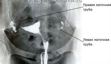 Trecerea trompelor uterine - blogul meu beteshka