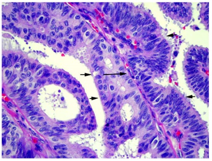 Cancerul de sân - Tipuri histologice