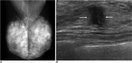 Cancerul de sân - Tipuri histologice