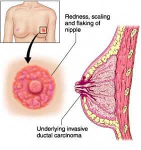 Cancerul de sân - Tipuri histologice