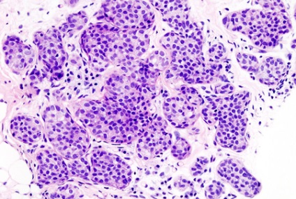 Cancerul de sân - Tipuri histologice