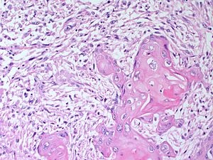 Cancerul de sân - Tipuri histologice