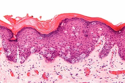 Cancerul de sân - Tipuri histologice