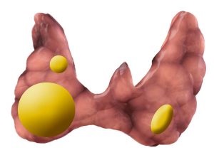 Tratamentul cancerului tiroidian cu hormoni și iod radioactiv