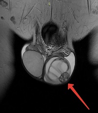 Cancerul testicular la bărbați simptome, diagnostic și metode de tratament