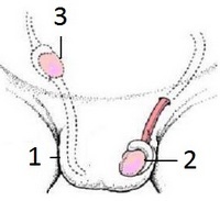 Cancerul testicular la bărbați simptome, diagnostic și metode de tratament