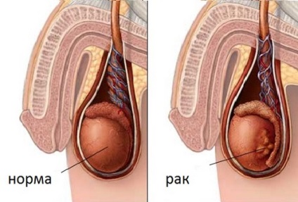 Cancerul testicular la bărbați simptome, diagnostic și metode de tratament