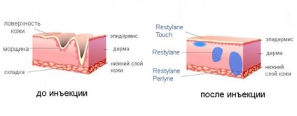 Рестилайн витав (restylane vital) - ефект від однієї процедури