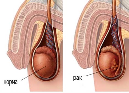 Seminomul testiculelor cum să tratăm
