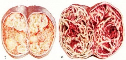 Seminomul testiculelor cum să tratăm