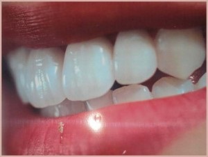 Îndepărtarea dinților mobili cu boală parodontală