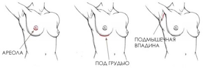 Силіконові груди плюси і мінуси ендопротезів грудей