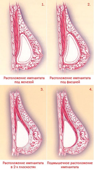 Siluri de sân plus și minus de proteze de sân