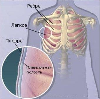 Симптоми плевриту легких у дорослих