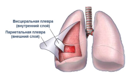 Симптоми плевриту легких у дорослих