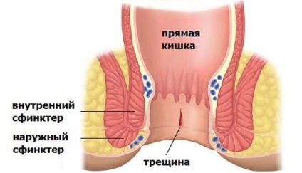 Симптоми захворювання прямої кишки у чоловіків і жінок