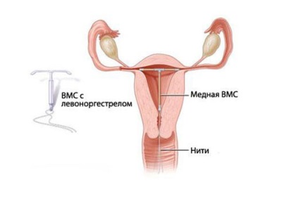 Спіраль при мастопатії можна ставити мирний і інші, чи може викликати спіраль мастопатію