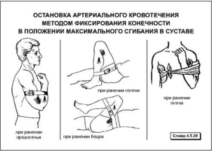 Способи тимчасової зупинки кровотечі - студопедія