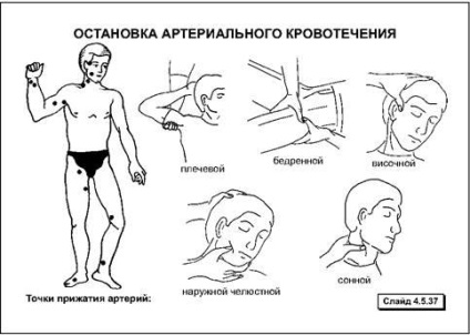 Способи тимчасової зупинки кровотечі - студопедія