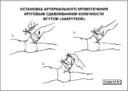 Способи тимчасової зупинки кровотечі - студопедія