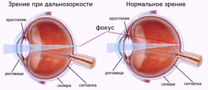 Gradele diagnosticului hipermetropiei, cauze