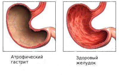 Субатрофіческій гастрит - його симптоми і лікування